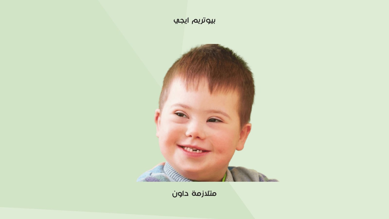 متلازمة داون